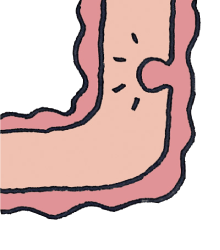 日帰り大腸ポリープ切除術