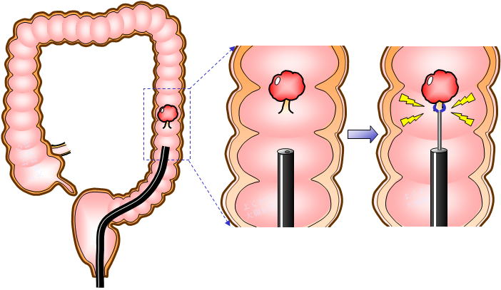 大腸ポリープ切除方法